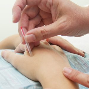 acupuncture hand treatment